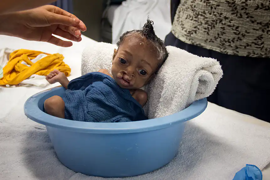 web_MSAU-IMAGE-PAUL-CHILDRENSHEALTH-CLEFT LIP