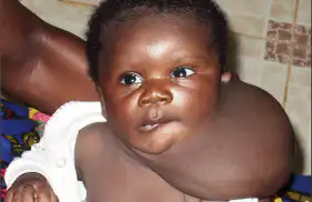 Cyrus – Child’s Health Goiter