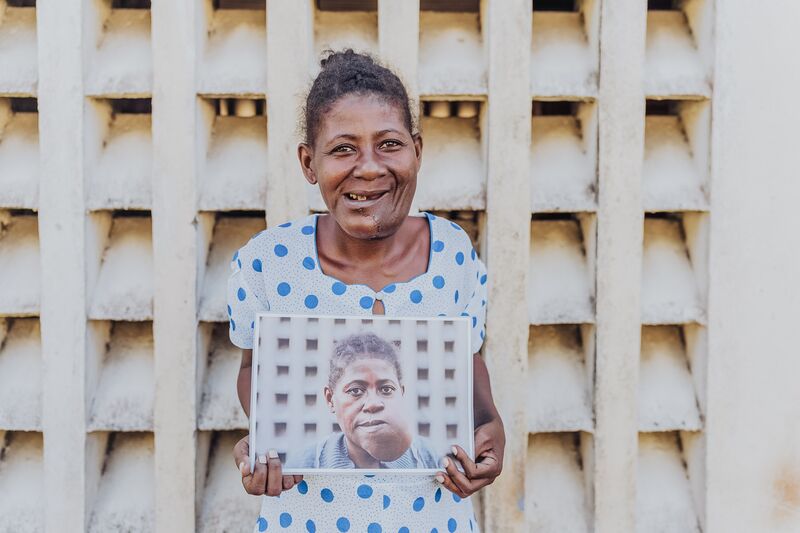 Theogette, maxillofacial patient, holding her after photo.