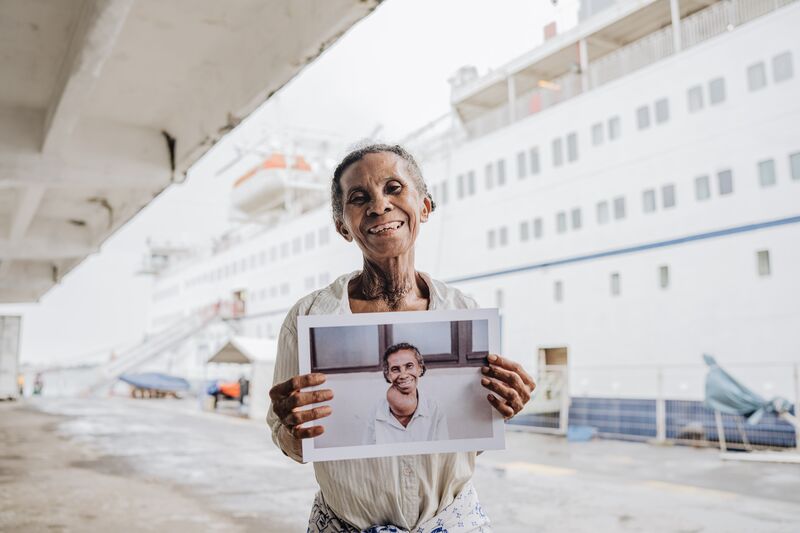 Vaviroa, maxillofacial patient, after her surgery.